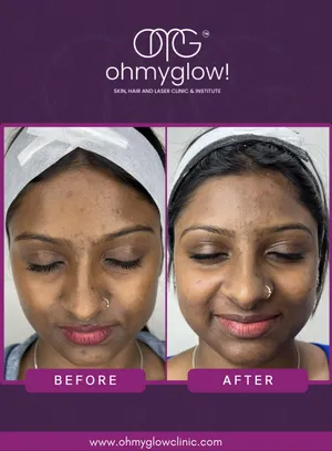 Before and after treatment result 10 at Oh My Glow Clinic, Chandigarh