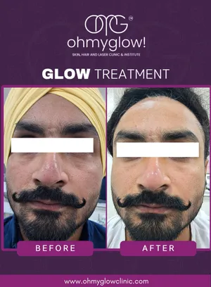 Before and after Glow treatment at Oh My Glow Clinic, Chandigarh