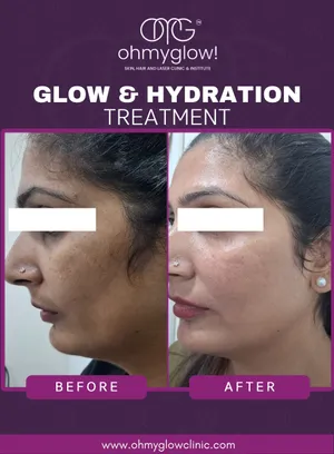 Before and after Glow & Hydration treatment at Oh My Glow Clinic, Chandigarh