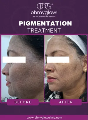 Before and after Pigmentation treatment at Oh My Glow Clinic, Chandigarh