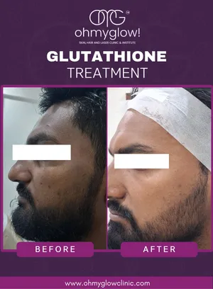 Before and after Glutathione treatment at Oh My Glow Clinic, Chandigarh