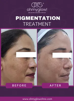 Before and after Pigmentation treatment at Oh My Glow Clinic, Chandigarh