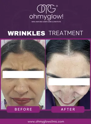 Before and after Wrinkles treatment at Oh My Glow Clinic, Chandigarh