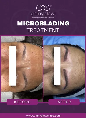 Before and after Microblading treatment at Oh My Glow Clinic, Chandigarh