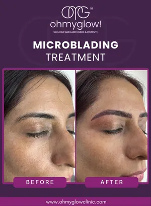 Before and after Microblading treatment at Oh My Glow Clinic, Chandigarh