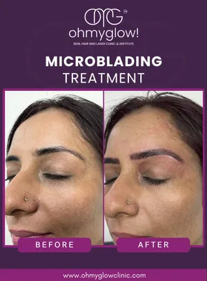 Before and after Microblading treatment at Oh My Glow Clinic, Chandigarh
