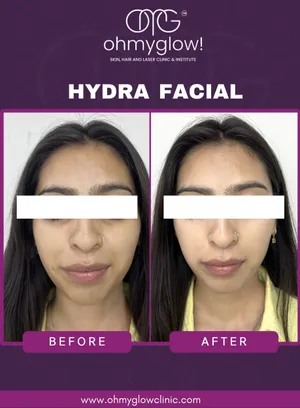 Before and after Hydra Facial treatment at Oh My Glow Clinic, Chandigarh