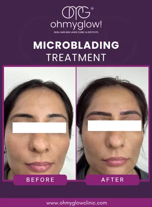 Before and after Microblading treatment at Oh My Glow Clinic, Chandigarh