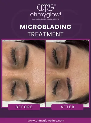Before and after Microblading treatment at Oh My Glow Clinic, Chandigarh