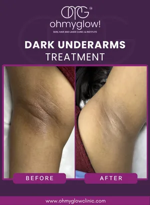 Before and after Dark Underarms treatment at Oh My Glow Clinic, Chandigarh