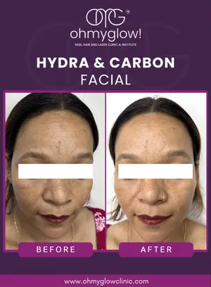 Before and after Hydra & Carbon Facial treatment at Oh My Glow Clinic, Chandigarh