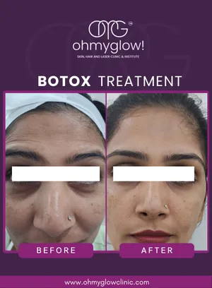 Before and after Botox treatment at Oh My Glow Clinic, Chandigarh