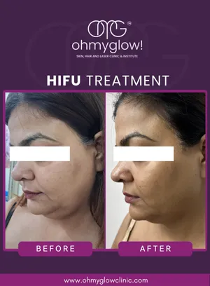 Before and after HIFU treatment at Oh My Glow Clinic, Chandigarh