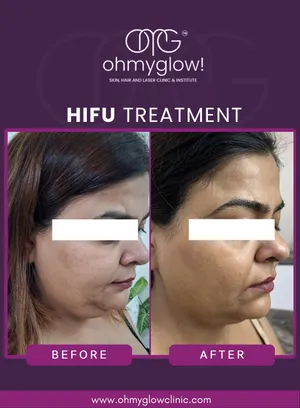 Before and after HIFU treatment at Oh My Glow Clinic, Chandigarh