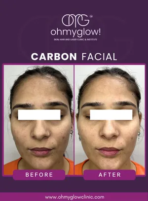 Before and after Carbon Facial treatment at Oh My Glow Clinic, Chandigarh