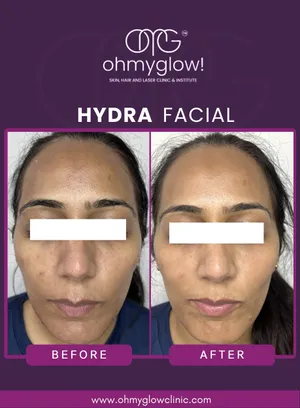 Before and after Hydra Facial treatment at Oh My Glow Clinic, Chandigarh