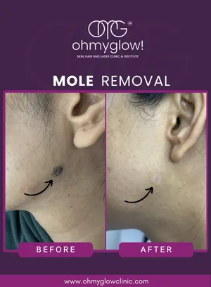 Before and after Mole Removal treatment at Oh My Glow Clinic, Chandigarh