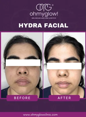 Before and after Hydra Facial treatment at Oh My Glow Clinic, Chandigarh