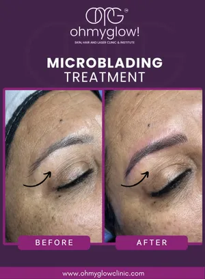 Before and after Microblading treatment at Oh My Glow Clinic, Chandigarh