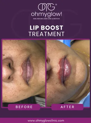 Before and after Lip Boost treatment at Oh My Glow Clinic, Chandigarh