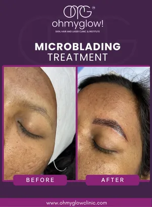 Before and after Microblading treatment at Oh My Glow Clinic, Chandigarh