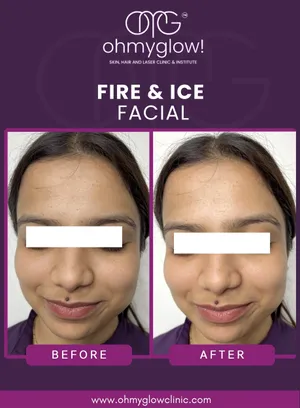 Before and after Fire & Ice Facial treatment at Oh My Glow Clinic, Chandigarh