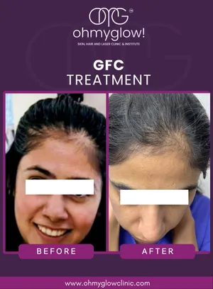 Before and after GFC treatment at Oh My Glow Clinic, Chandigarh