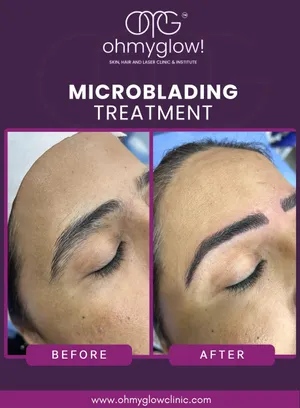 Before and after Microblading treatment at Oh My Glow Clinic, Chandigarh