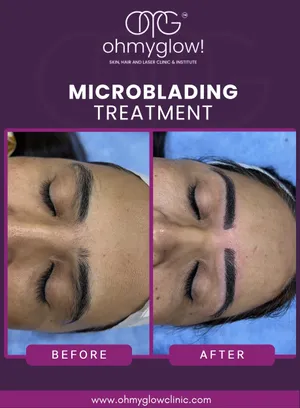 Before and after Microblading treatment at Oh My Glow Clinic, Chandigarh