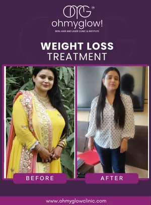Before and after Weight Loss treatment at Oh My Glow Clinic, Chandigarh