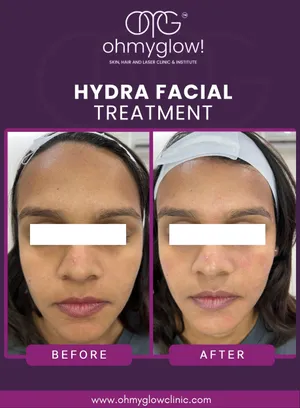 Before and after Hydra Facial treatment at Oh My Glow Clinic, Chandigarh