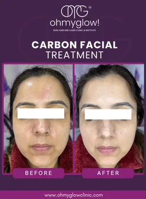 Before and after Carbon Facial treatment at Oh My Glow Clinic, Chandigarh