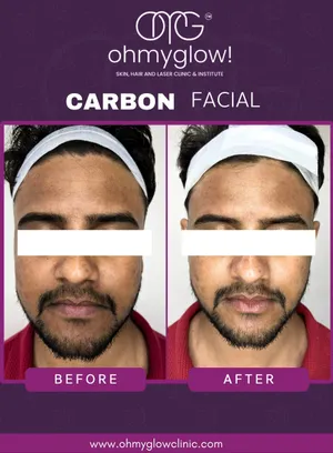 Before and after Carbon Facial treatment at Oh My Glow Clinic, Chandigarh