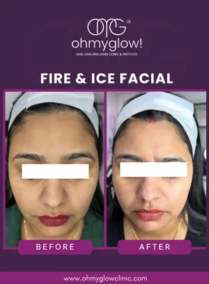 Before and after Fire & Ice Facial treatment at Oh My Glow Clinic, Chandigarh