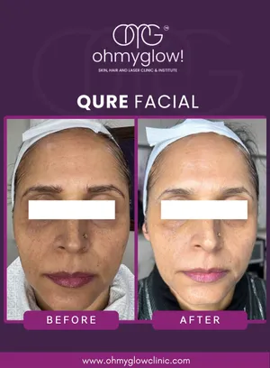 Before and after Qure Facial treatment at Oh My Glow Clinic, Chandigarh
