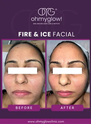 Before and after Fire & Ice Facial treatment at Oh My Glow Clinic, Chandigarh