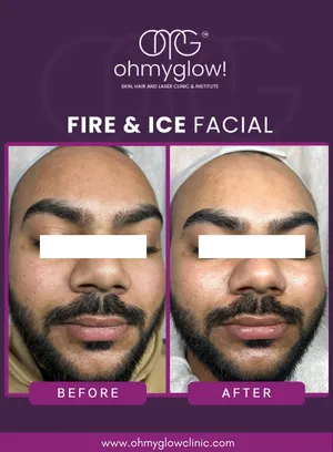 Before and after Fire & Ice Facial treatment at Oh My Glow Clinic, Chandigarh