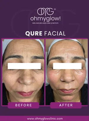 Before and after Qure Facial treatment at Oh My Glow Clinic, Chandigarh