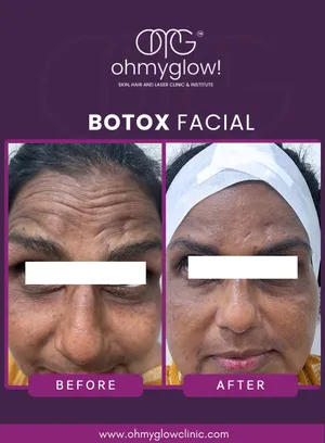 Before and after Botox treatment at Oh My Glow Clinic, Chandigarh