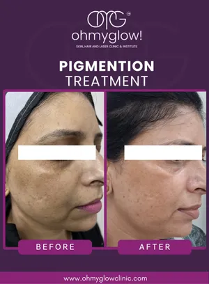 Before and after Pigmentation treatment at Oh My Glow Clinic, Chandigarh
