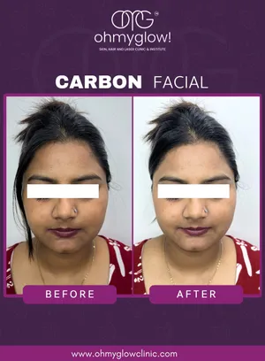 Before and after Carbon Facial treatment at Oh My Glow Clinic, Chandigarh