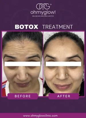 Before and after Botox treatment at Oh My Glow Clinic, Chandigarh