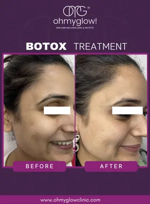 Before and after Botox treatment at Oh My Glow Clinic, Chandigarh