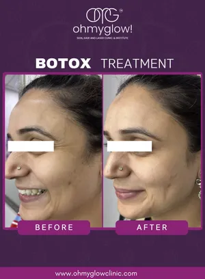 Before and after Botox treatment at Oh My Glow Clinic, Chandigarh
